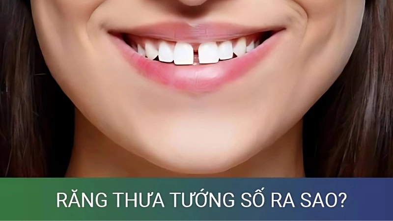 Khám phá vận mệnh qua tướng người răng thưa đầy đủ nhất