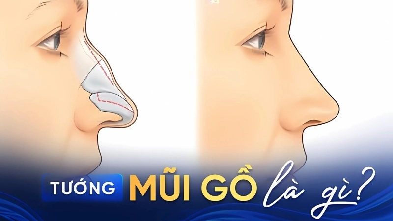 Xem tướng mũi gồ để hiểu rõ vận khí và sự nghiệp tương lai